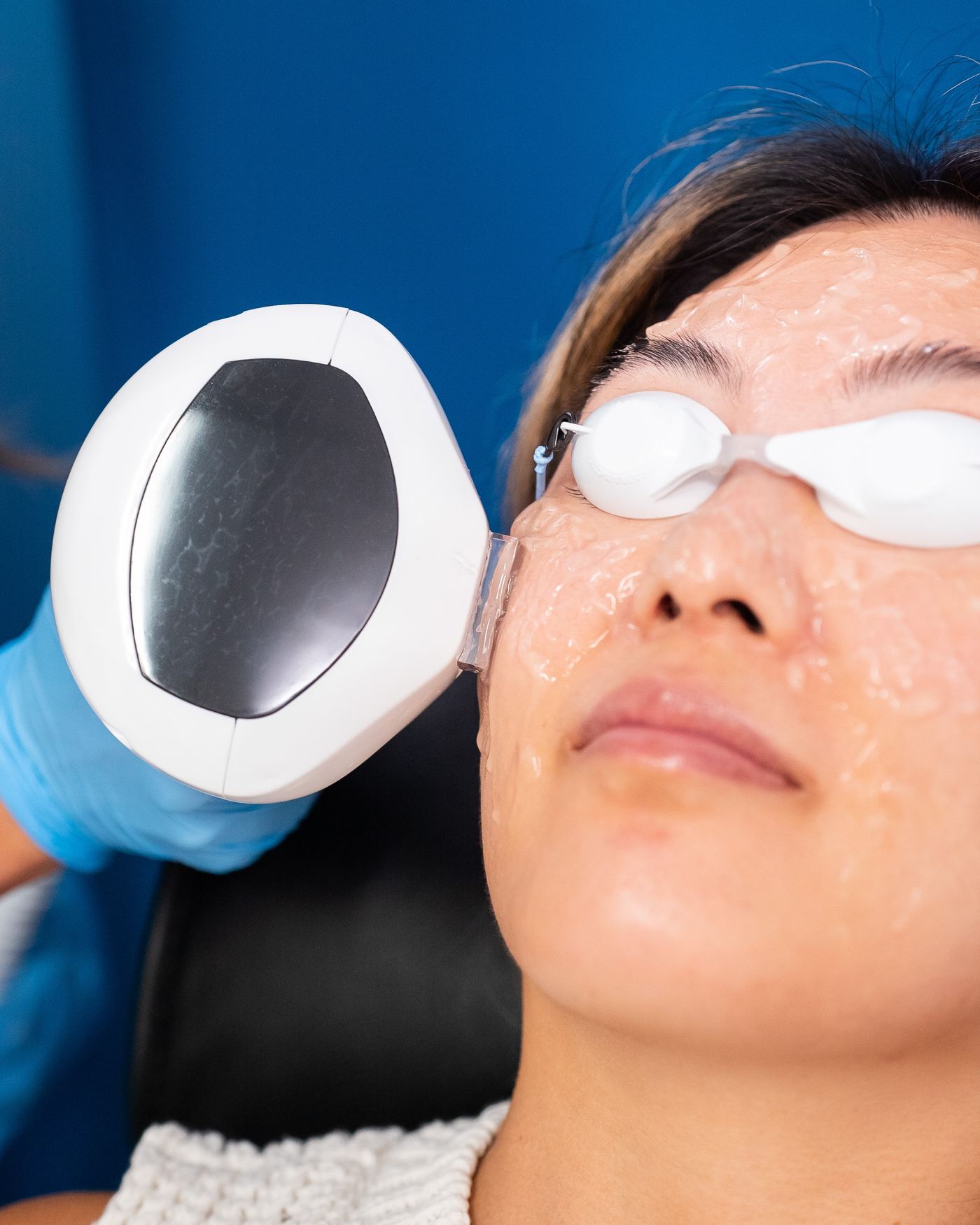 A close view of the Lumecca IPL handpiece beside a patient's face, her eyes covered by protective goggles
